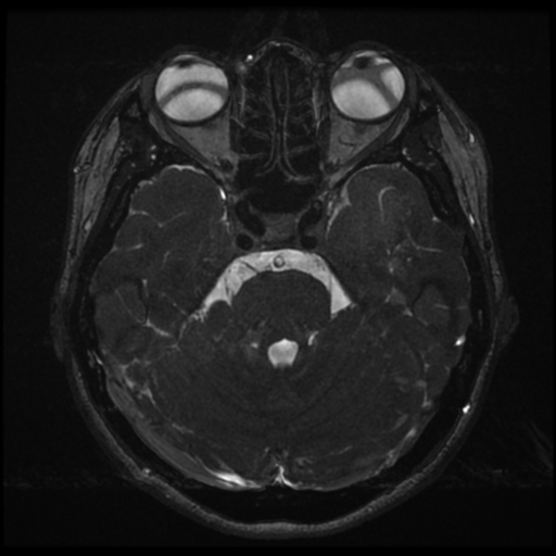 File:Acoustic neuroma (Radiopaedia 34049-35283 Axial 74).png