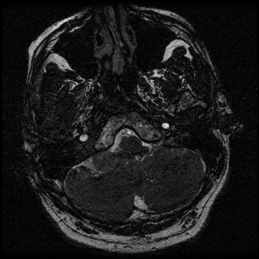 File:Acoustic schwannoma (Radiopaedia 39170-41387 Axial FIESTA 37).png