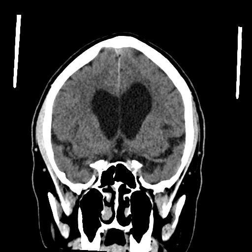 File:Acoustic schwannoma (Radiopaedia 55729-62280 Coronal non-contrast 17).png