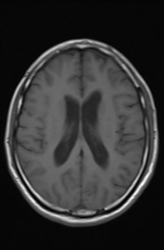 Acoustic schwannoma - probable (Radiopaedia 20386-20292 Axial T1 12).jpg
