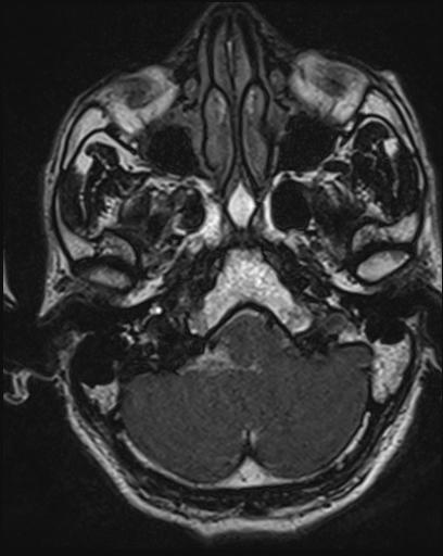 Acoustic schwannoma - probable (Radiopaedia 20386-20292 Axial T1 25).jpg