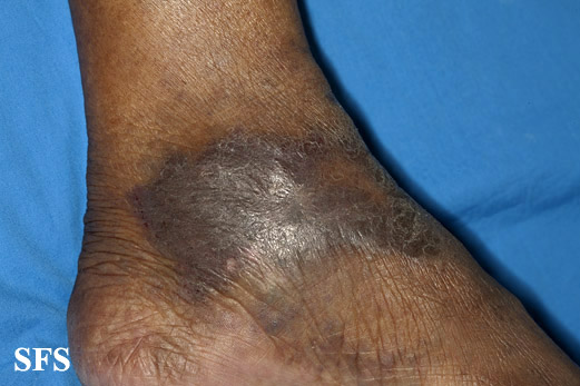 File:Acroangiodermatitis (Dermatology Atlas 3).jpg
