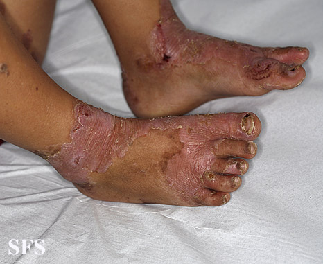 File:Acrodermatitis Enteropathica (Dermatology Atlas 39).jpg