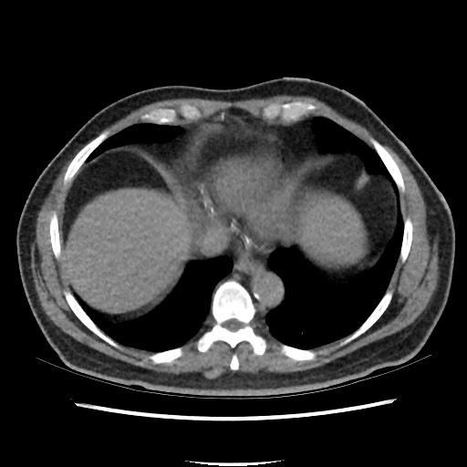 Active colonic bleed on CT (Radiopaedia 49765-55025 Axial non-contrast 3).jpg