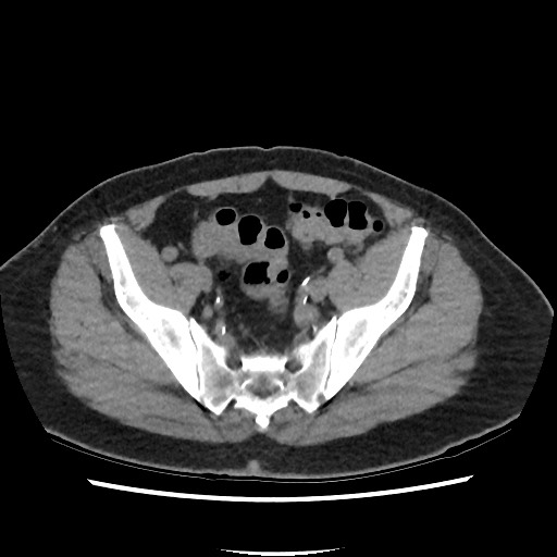 Active colonic bleed on CT (Radiopaedia 49765-55025 Axial non-contrast 67).jpg