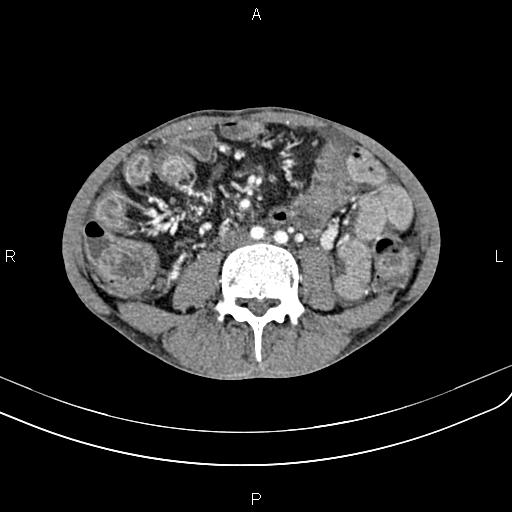 Active crohn disease (Radiopaedia 87133-103397 Axial C+ arterial phase 60).jpg