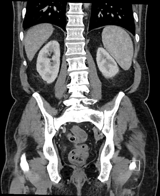 Active lower gastrointestinal bleeding - diverticular (Radiopaedia 61203-69106 Coronal C+ portal venous phase 96).jpg