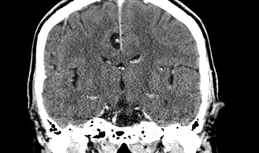 File:Active neurocysticercosis before and after therapy (Radiopaedia 71710-82099 Coronal 3).jpg
