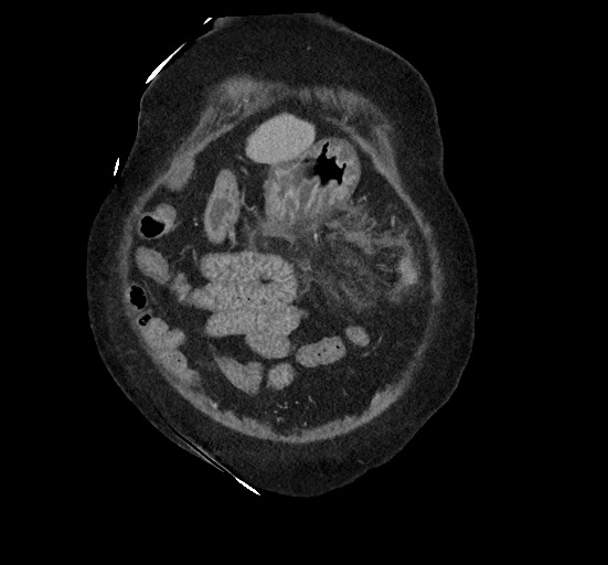 Active renal extravasation with large subcapsular and retroperitoneal hemorrhage (Radiopaedia 60975-68796 Coronal C+ portal venous phase 33).jpg