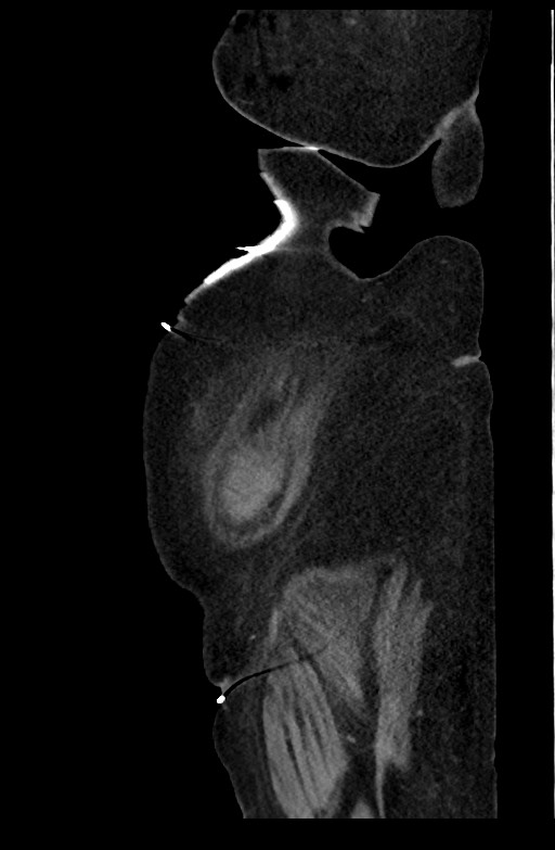 Active renal extravasation with large subcapsular and retroperitoneal hemorrhage (Radiopaedia 60975-68796 Sagittal C+ portal venous phase 35).jpg