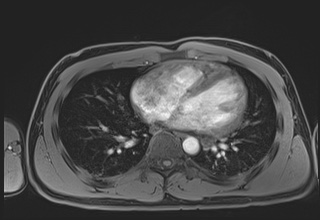 File:Active right ventricular cardiac sarcoidosis (Radiopaedia 55596-62100 Axial Post contrast Dixon 46).jpg