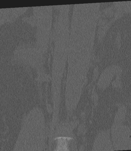 Acute L1 burst compression fracture (Radiopaedia 34430-35755 Coronal bone window 6).png