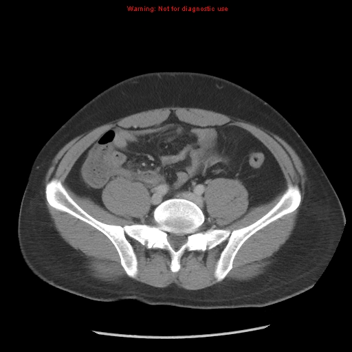 Acute appendicitis (Radiopaedia 10498-10973 Axial C+ portal venous phase 23).jpg