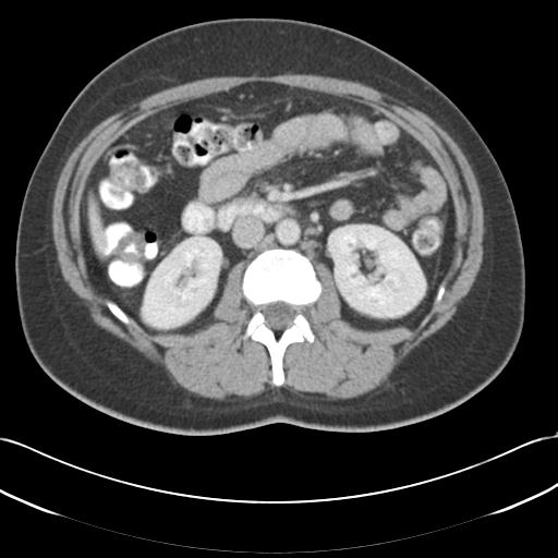 Acute appendicitis (Radiopaedia 30297-30934 Axial C+ portal venous phase 36).jpg