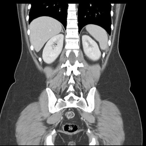 Acute appendicitis (Radiopaedia 30297-30934 Coronal C+ portal venous phase 35).jpg