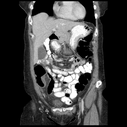 File:Acute appendicitis (Radiopaedia 52672-58589 Coronal C+ portal venous phase 17).jpg