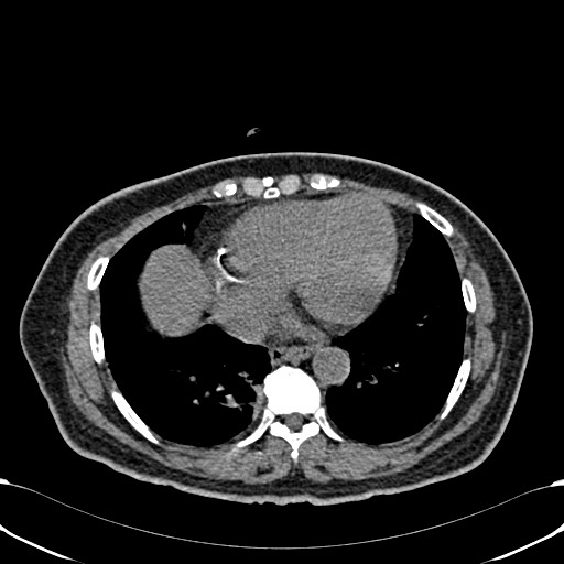 File:Acute appendicitis (Radiopaedia 58627-65818 Axial non-contrast 7).jpg