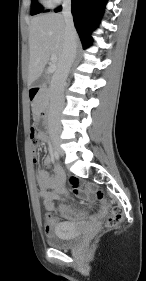 Acute appendicitis (Radiopaedia 62608-70901 Sagittal C+ portal venous phase 26).jpg