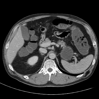 File:Acute appendicitis (Radiopaedia 66513-75790 Axial C+ portal venous phase 14).jpg