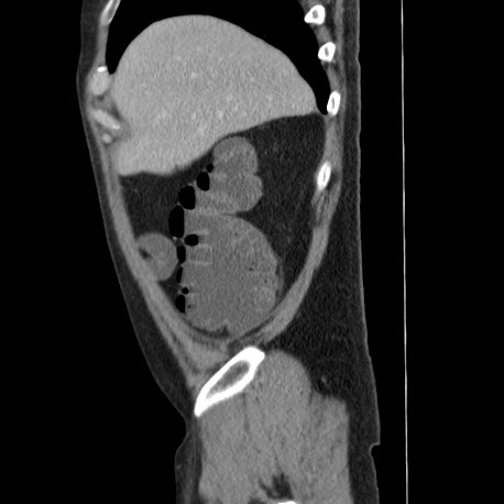 Acute appendicitis (Radiopaedia 66513-75790 Sagittal C+ portal venous phase 19).jpg