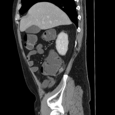 Acute appendicitis (Radiopaedia 66513-75790 Sagittal C+ portal venous phase 36).jpg