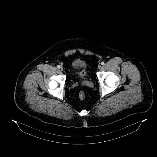 Acute appendicitis (Radiopaedia 79950-93224 Axial C+ portal venous phase 94).jpg