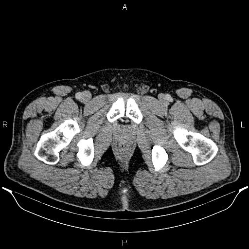 Acute appendicitis (Radiopaedia 84780-100240 Axial C+ portal venous phase 113).jpg