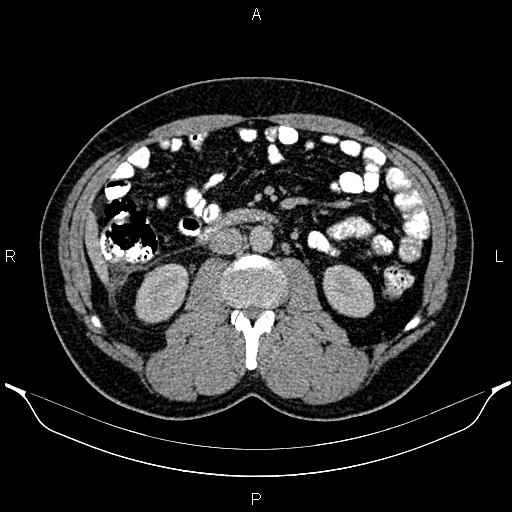 Acute appendicitis (Radiopaedia 84780-100240 Axial C+ portal venous phase 50).jpg