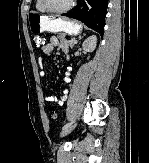 Acute appendicitis (Radiopaedia 84780-100240 Sagittal C+ portal venous phase 69).jpg