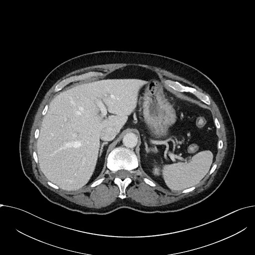 File:Acute appendicitis - large appendicoliths (Radiopaedia 61805-69820 Axial C+ portal venous phase 28).jpg