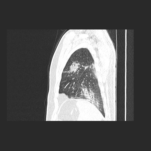 File:Acute appendicitis and COVID 19 pneumonia (Radiopaedia 76604-88380 Sagittal lung window 79).jpg