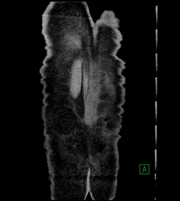 Acute arterial mesenteric ischemia (Radiopaedia 78238-90828 Coronal C+ portal venous phase 88).jpg