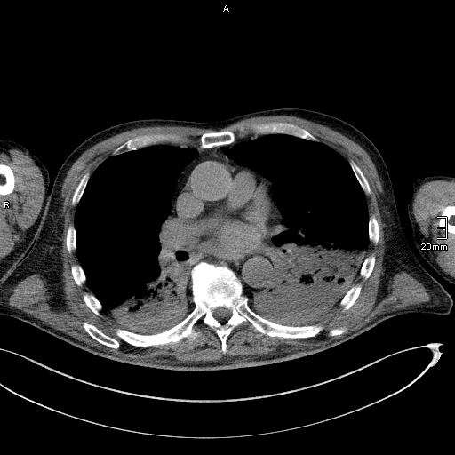 Acute aspiration pneumonitis (Radiopaedia 55642-62166 Axial liver window 33).jpg