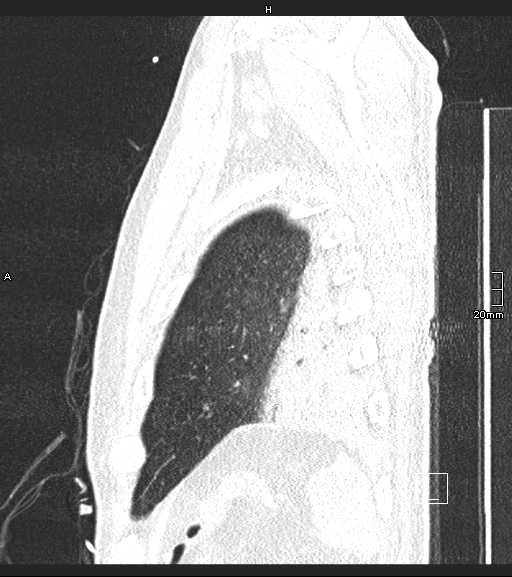Acute aspiration pneumonitis (Radiopaedia 55642-62166 Sagittal lung window 10).jpg