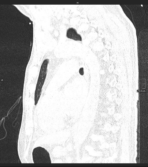 Acute aspiration pneumonitis (Radiopaedia 55642-62166 Sagittal lung window 64).jpg