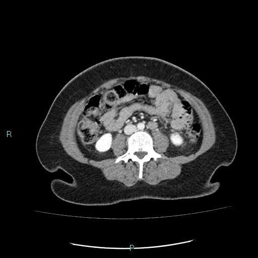 Acute bilateral pyelonephritis (Radiopaedia 37146-38881 Axial C+ portal venous phase 58).jpg