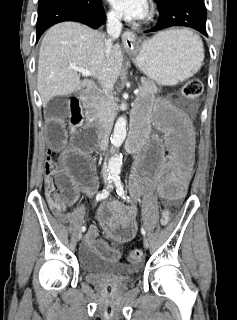 Acute bowel ischemia (Radiopaedia 87695-104114 Coronal C+ portal venous phase 202).jpg