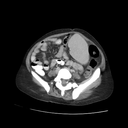 Acute calculous cholecystitis in patient with osteopetrosis (Radiopaedia 77871-90159 Axial C+ portal venous phase 56).jpg