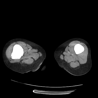 Acute calculous cholecystitis in patient with osteopetrosis (Radiopaedia 77871-90159 Axial C+ portal venous phase 92).jpg