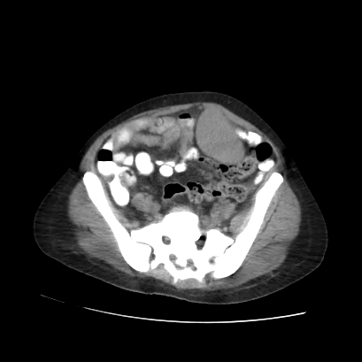 File:Acute calculous cholecystitis in patient with osteopetrosis (Radiopaedia 77871-90159 Axial non-contrast 61).jpg