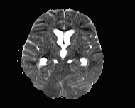 File:Acute cerebellar ataxia (Radiopaedia 61487-69446 Axial ADC 10).jpg