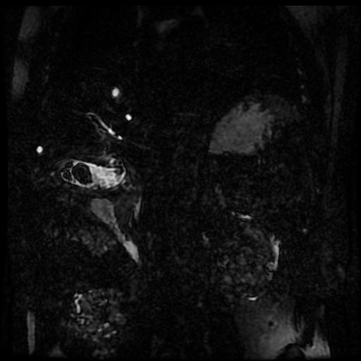 Acute cholecystitis and biliary hamartomas (Radiopaedia 86231-102240 E 50).jpg