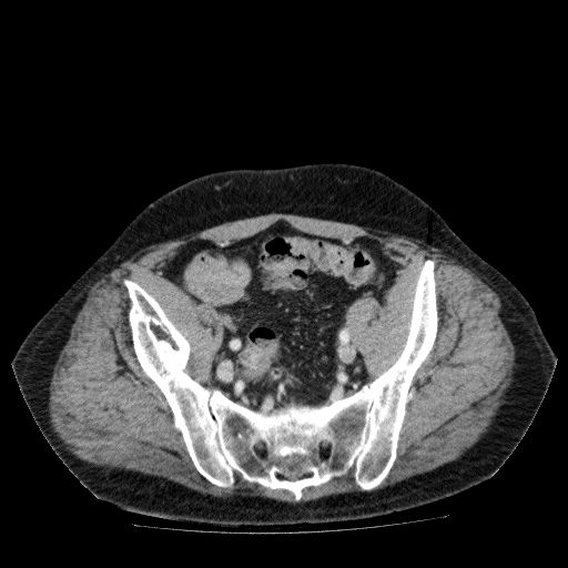 File:Acute cholecystitis and incidental left sided IVC (Radiopaedia 49352-54459 Axial C+ portal venous phase 124).jpg