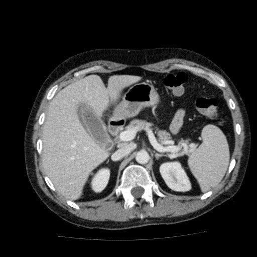 Acute cholecystitis and incidental left sided IVC (Radiopaedia 49352-54459 Axial C+ portal venous phase 51).jpg