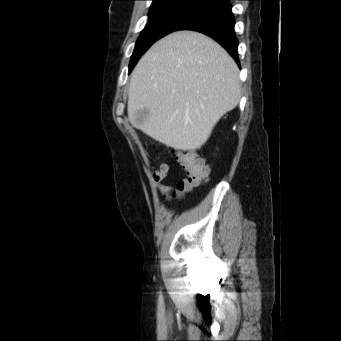 Acute cholecystitis and incidental left sided IVC (Radiopaedia 49352-54459 Sagittal C+ portal venous phase 73).jpg