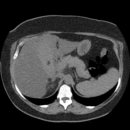 Acute cholecystitis and ureteric colic (Radiopaedia 42330-45444 Axial prone 20).jpg