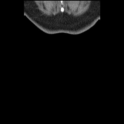Acute cholecystitis and ureteric colic (Radiopaedia 42330-45444 Coronal prone 105).jpg