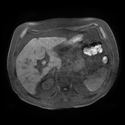 Acute cholecystitis complicated by pylephlebitis (Radiopaedia 65782-74915 Axial T1 fat sat 42).jpg