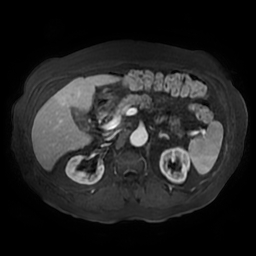 File:Acute cholecystitis complicated by pylephlebitis (Radiopaedia 65782-74915 Axial arterioportal phase T1 C+ fat sat 64).jpg