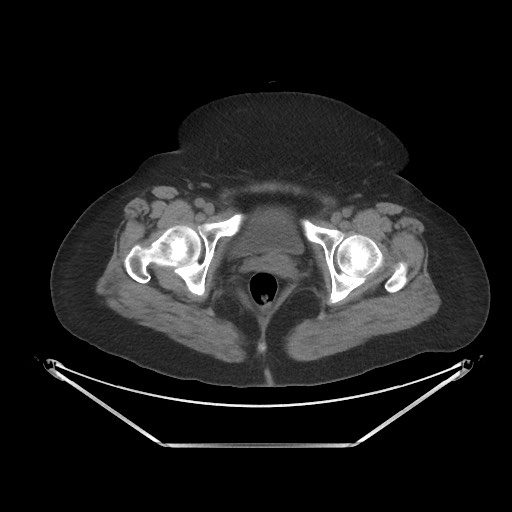 Acute cholecystitis with tensile fundus sign (Radiopaedia 71394-81723 Axial non-contrast 115).jpg